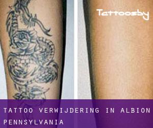 Tattoo verwijdering in Albion (Pennsylvania)