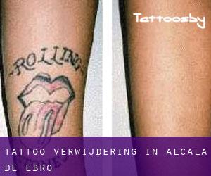Tattoo verwijdering in Alcalá de Ebro