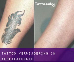 Tattoo verwijdering in Aldealafuente