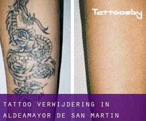 Tattoo verwijdering in Aldeamayor de San Martín