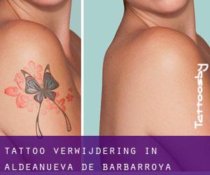 Tattoo verwijdering in Aldeanueva de Barbarroya