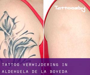 Tattoo verwijdering in Aldehuela de la Bóveda