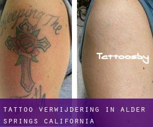 Tattoo verwijdering in Alder Springs (California)