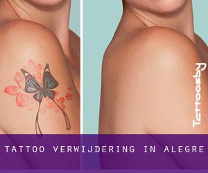 Tattoo verwijdering in Alegre