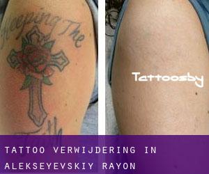 Tattoo verwijdering in Alekseyevskiy Rayon