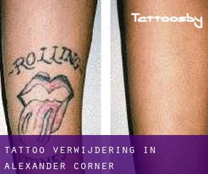 Tattoo verwijdering in Alexander Corner