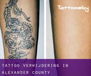 Tattoo verwijdering in Alexander County
