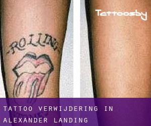 Tattoo verwijdering in Alexander Landing