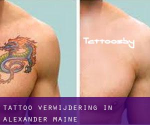 Tattoo verwijdering in Alexander (Maine)