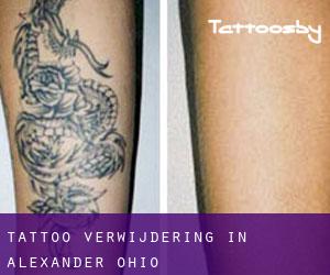 Tattoo verwijdering in Alexander (Ohio)