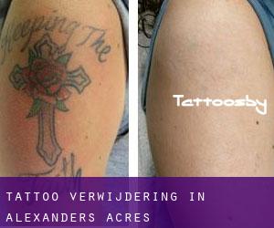 Tattoo verwijdering in Alexanders Acres