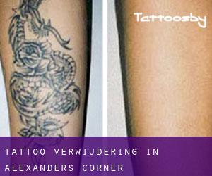 Tattoo verwijdering in Alexanders Corner