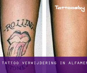 Tattoo verwijdering in Alfamén