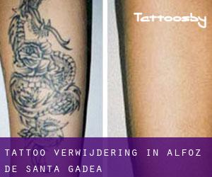 Tattoo verwijdering in Alfoz de Santa Gadea