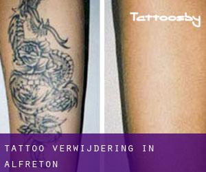 Tattoo verwijdering in Alfreton