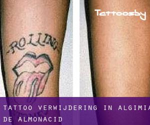 Tattoo verwijdering in Algimia de Almonacid