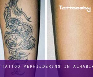 Tattoo verwijdering in Alhabia