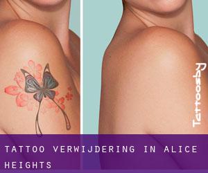 Tattoo verwijdering in Alice Heights