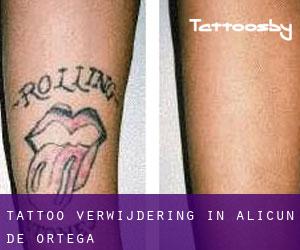 Tattoo verwijdering in Alicún de Ortega