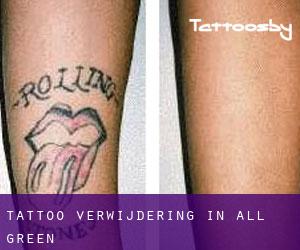 Tattoo verwijdering in All Green