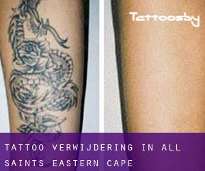 Tattoo verwijdering in All Saints (Eastern Cape)