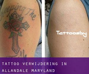 Tattoo verwijdering in Allandale (Maryland)