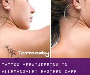 Tattoo verwijdering in Allemansvlei (Eastern Cape)