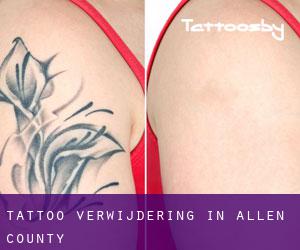 Tattoo verwijdering in Allen County