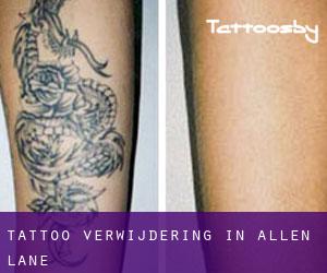 Tattoo verwijdering in Allen Lane