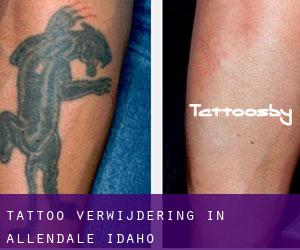 Tattoo verwijdering in Allendale (Idaho)