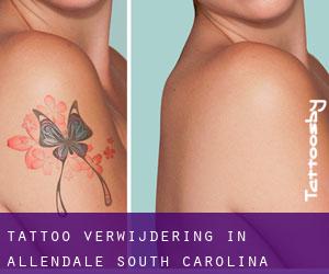 Tattoo verwijdering in Allendale (South Carolina)
