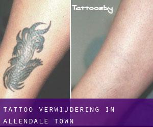 Tattoo verwijdering in Allendale Town