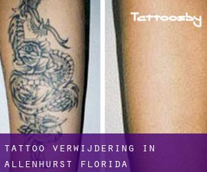 Tattoo verwijdering in Allenhurst (Florida)