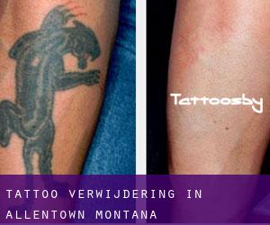 Tattoo verwijdering in Allentown (Montana)