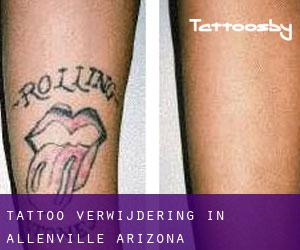 Tattoo verwijdering in Allenville (Arizona)