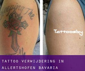 Tattoo verwijdering in Allertshofen (Bavaria)