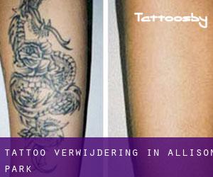Tattoo verwijdering in Allison Park