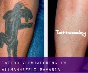 Tattoo verwijdering in Allmannsfeld (Bavaria)