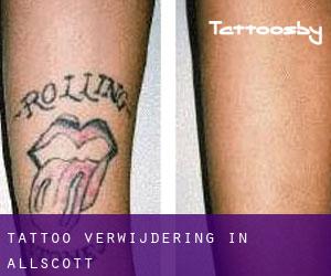 Tattoo verwijdering in Allscott