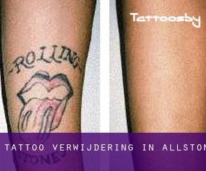Tattoo verwijdering in Allston
