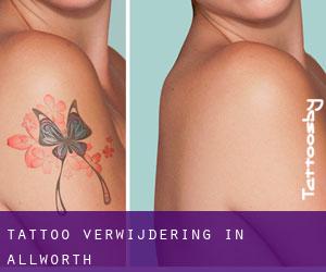 Tattoo verwijdering in Allworth