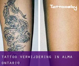 Tattoo verwijdering in Alma (Ontario)