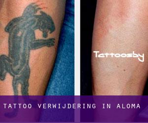 Tattoo verwijdering in Aloma