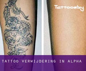 Tattoo verwijdering in Alpha