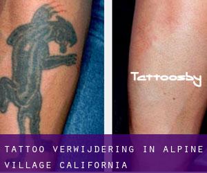 Tattoo verwijdering in Alpine Village (California)