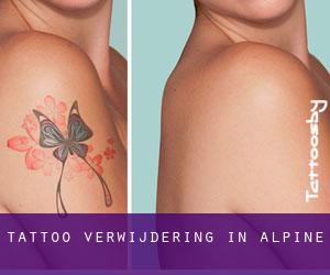 Tattoo verwijdering in Alpine