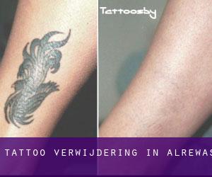 Tattoo verwijdering in Alrewas