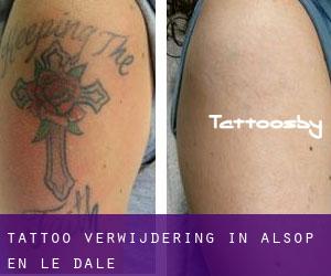 Tattoo verwijdering in Alsop en le Dale