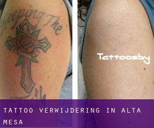 Tattoo verwijdering in Alta Mesa