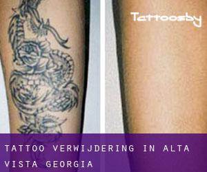 Tattoo verwijdering in Alta Vista (Georgia)